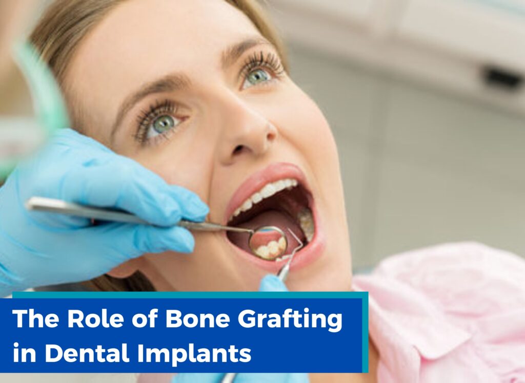 The Role of Bone Grafting in Dental Implants, what is bone grafting, dental implants in ludhiana, dental implants costs in ludhiana, what are dental implants, dental implants procedure, is it okay to choose dental implants, dentist in jamalpur, dentist in ludhiana