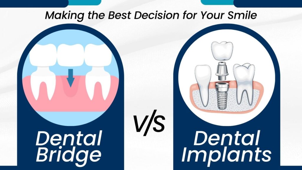 Dental Bridges vs Dental Implants, dental implants in ludhiana, dental implants price in ludhiana, Dental Clinic in Ludhiana, Dental Clinic in jamalpur, Dentist in ludhiana, Dentist in jamalpur, dental care, general dentistry, Thind Dental Clinic in Ludhiana