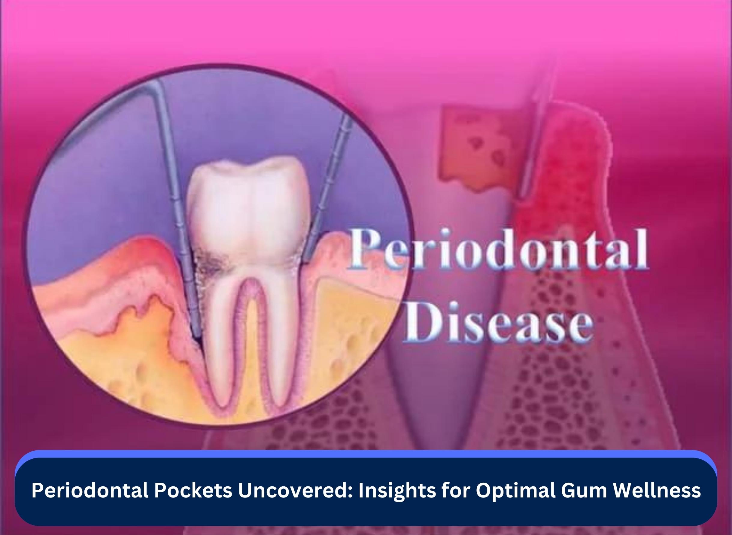 Periodontal Pockets Uncovered: Insights for Optimal Gum Wellness