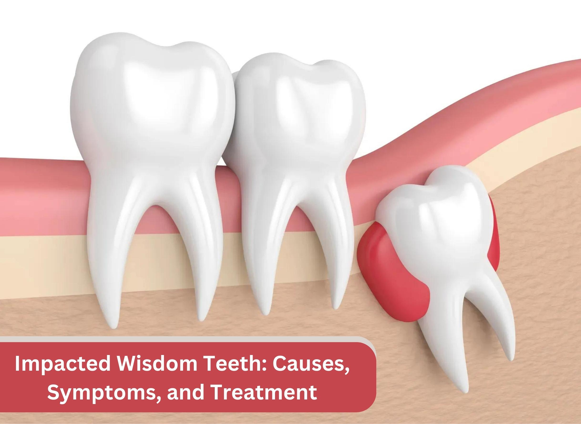 Impacted Wisdom Teeth Causes Symptoms And Treatment