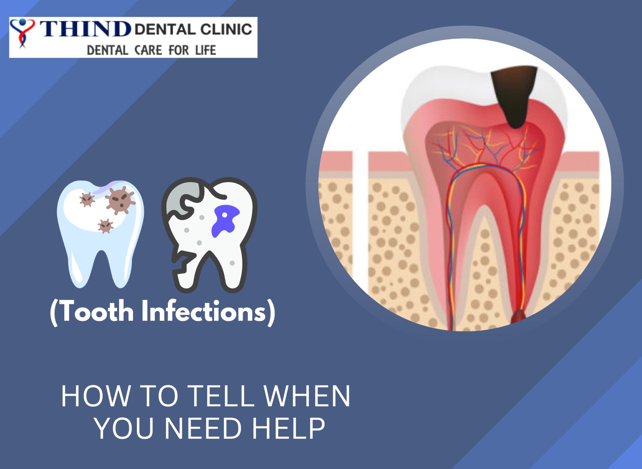 Tooth Infections How To Tell When You Need Help