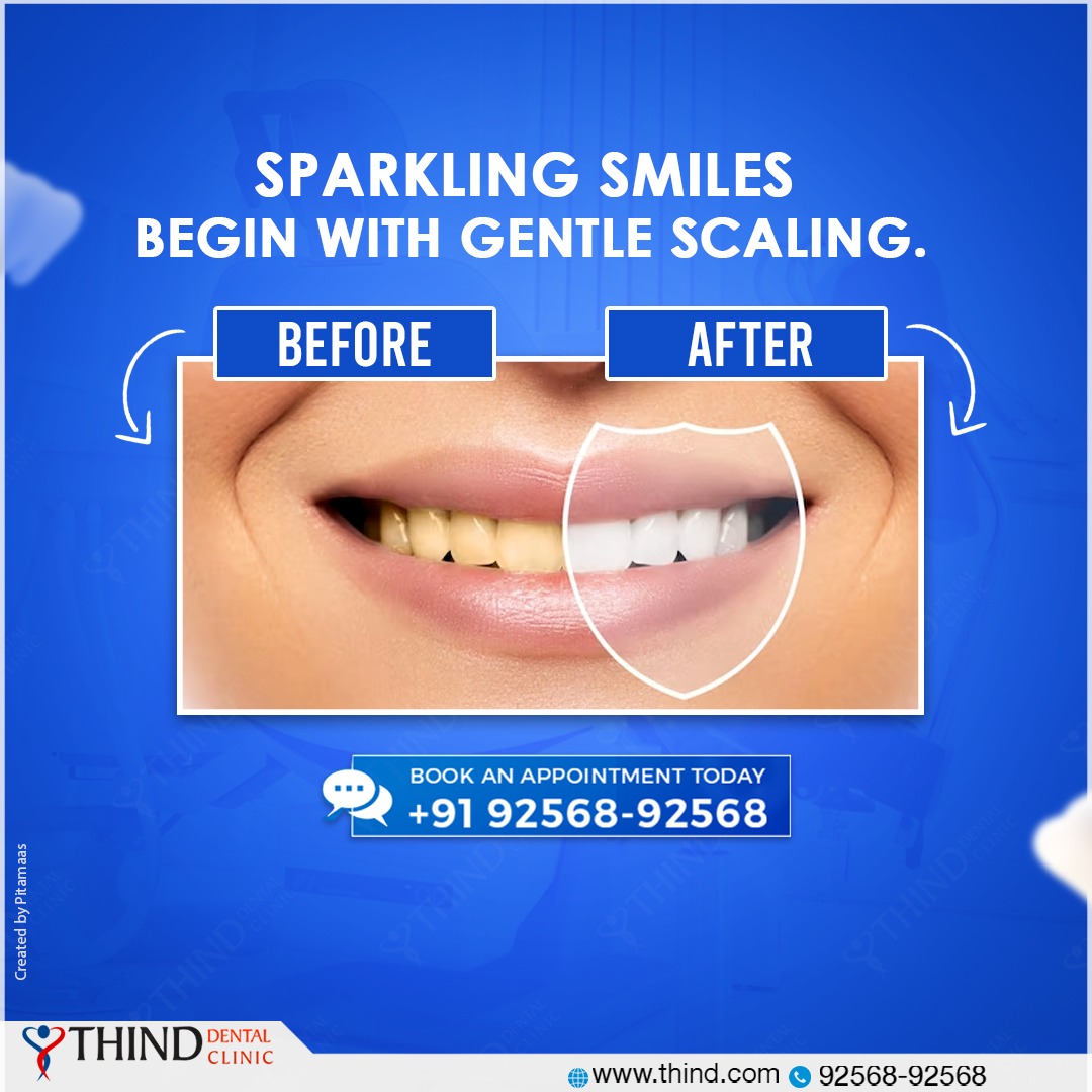 Sparkling Smiles Begin With Gentle Scaling At Thind Dental Clinic