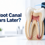 Can a Root Canal Fail Years Later?